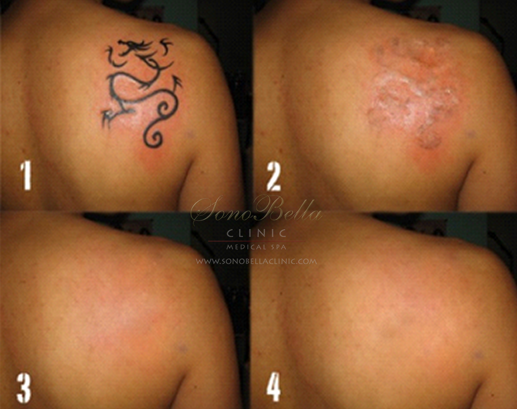 Laser Tattoo Removal Cost/Price in Delhi - Isaac Luxe