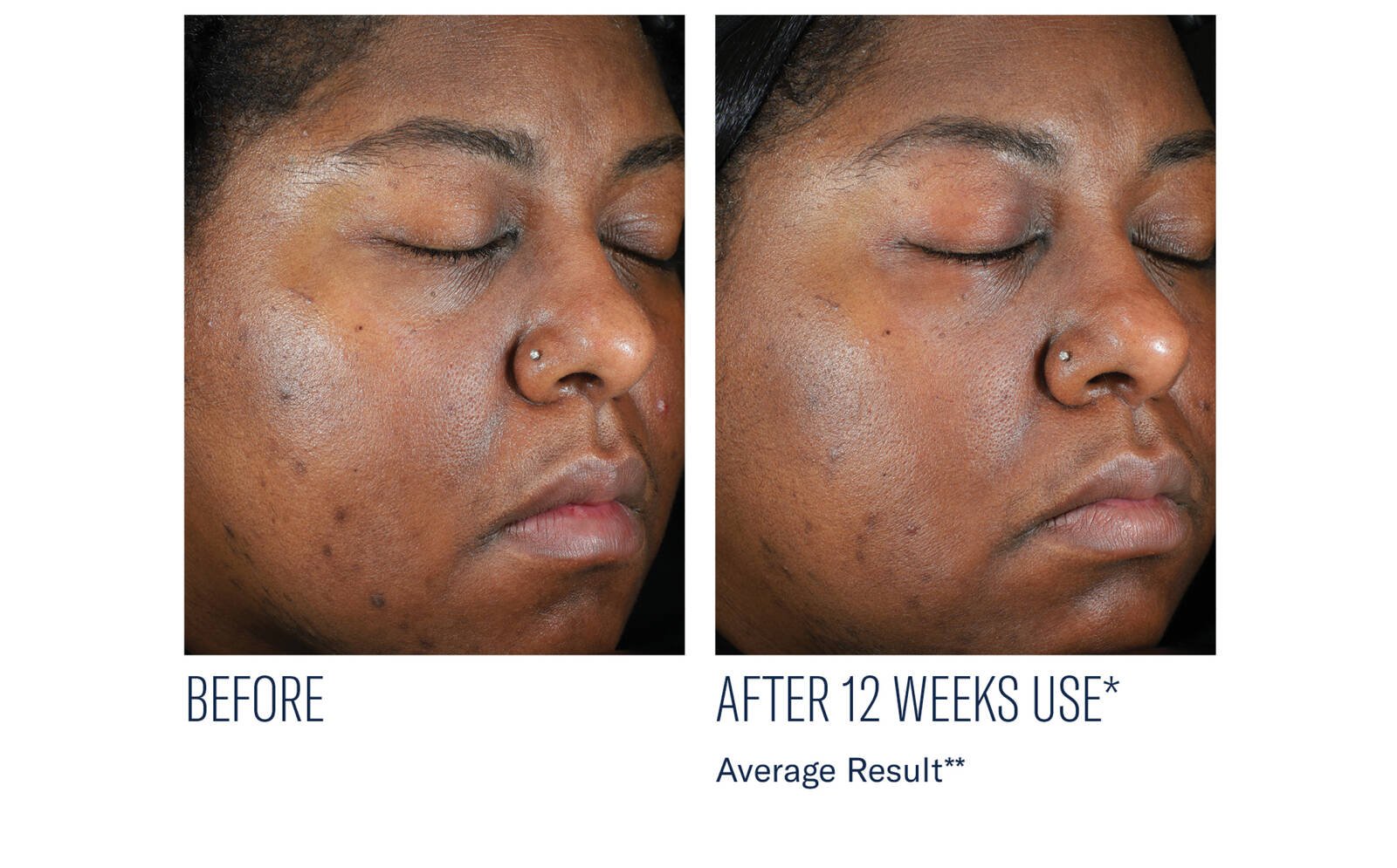 SkinBetter Science® Even Intensive Skin Tone Correcting Serum