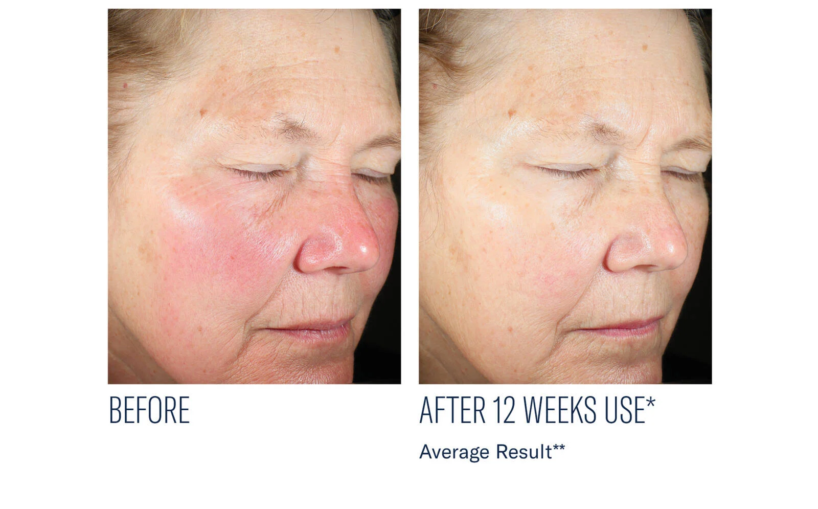 SkinBetter Science® Even Intensive Skin Tone Correcting Serum