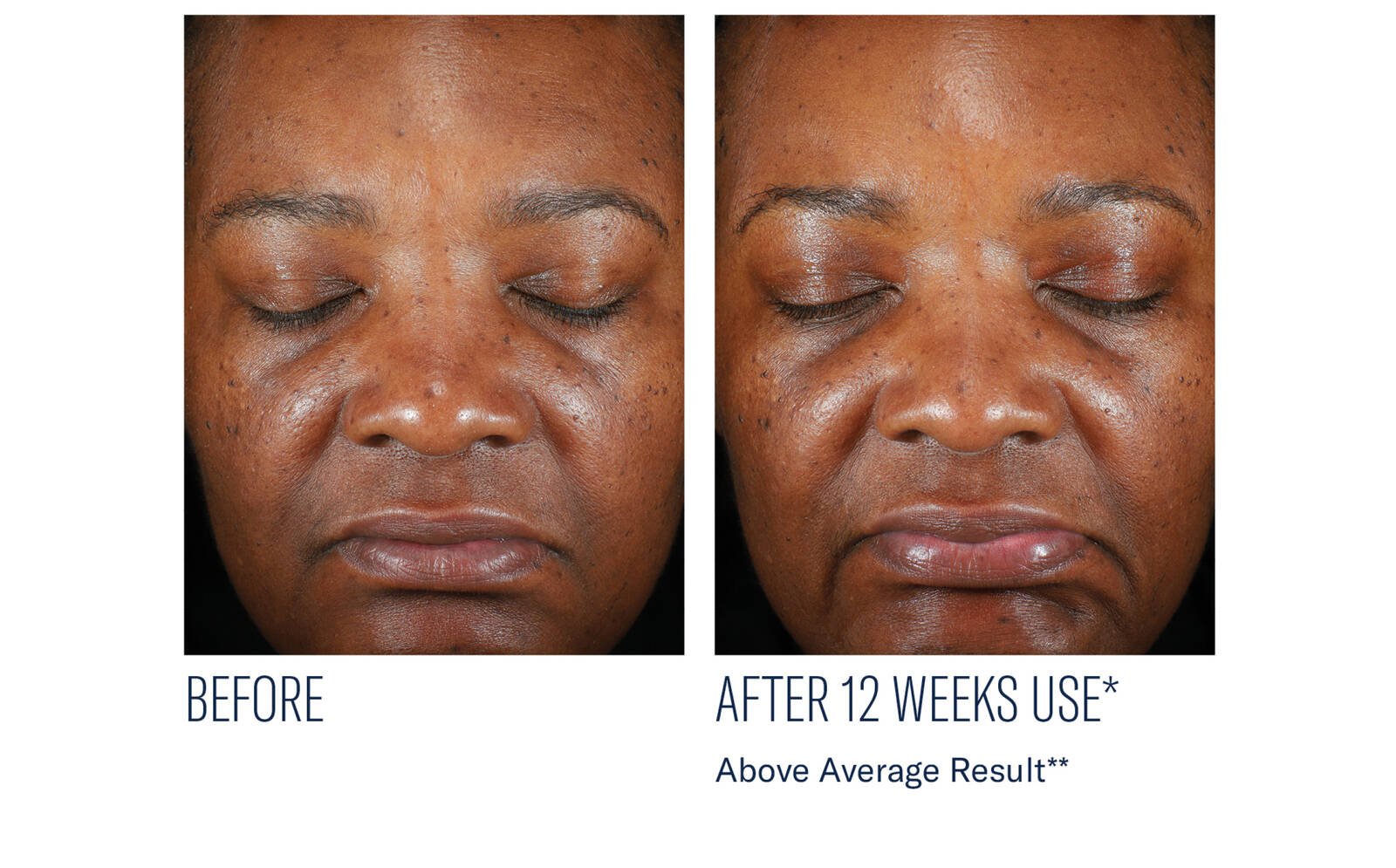 SkinBetter Science® Even Intensive Skin Tone Correcting Serum