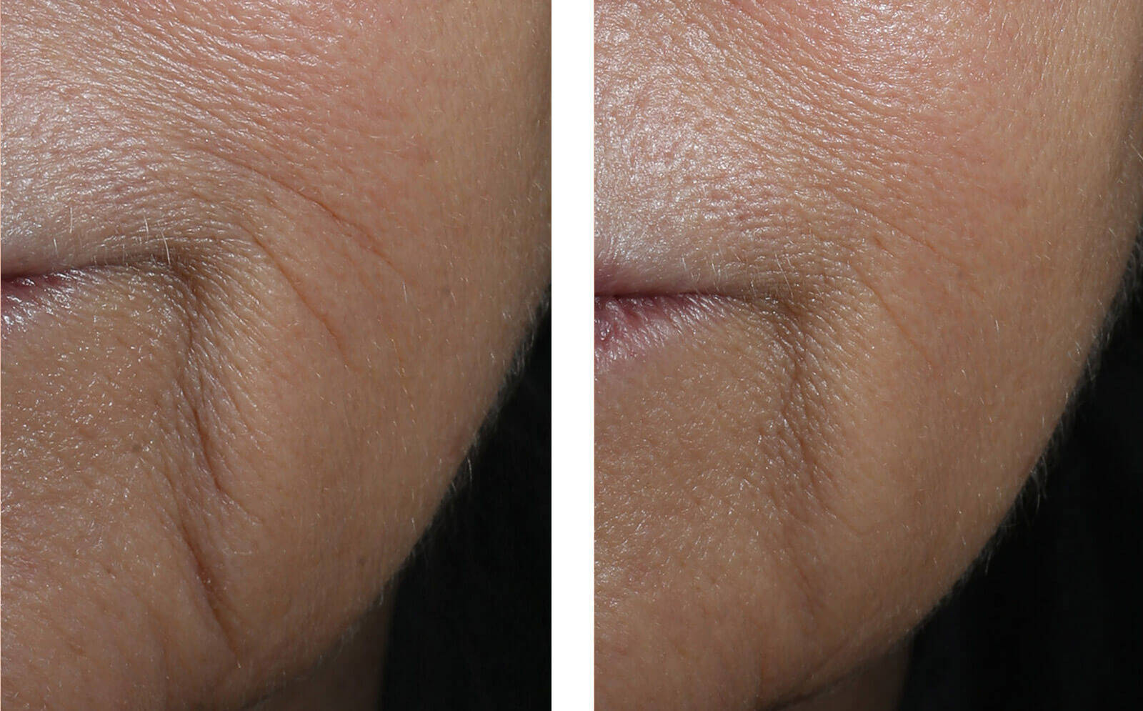 SkinBetter Science® InterFuse® Intensive Treatment LINES
