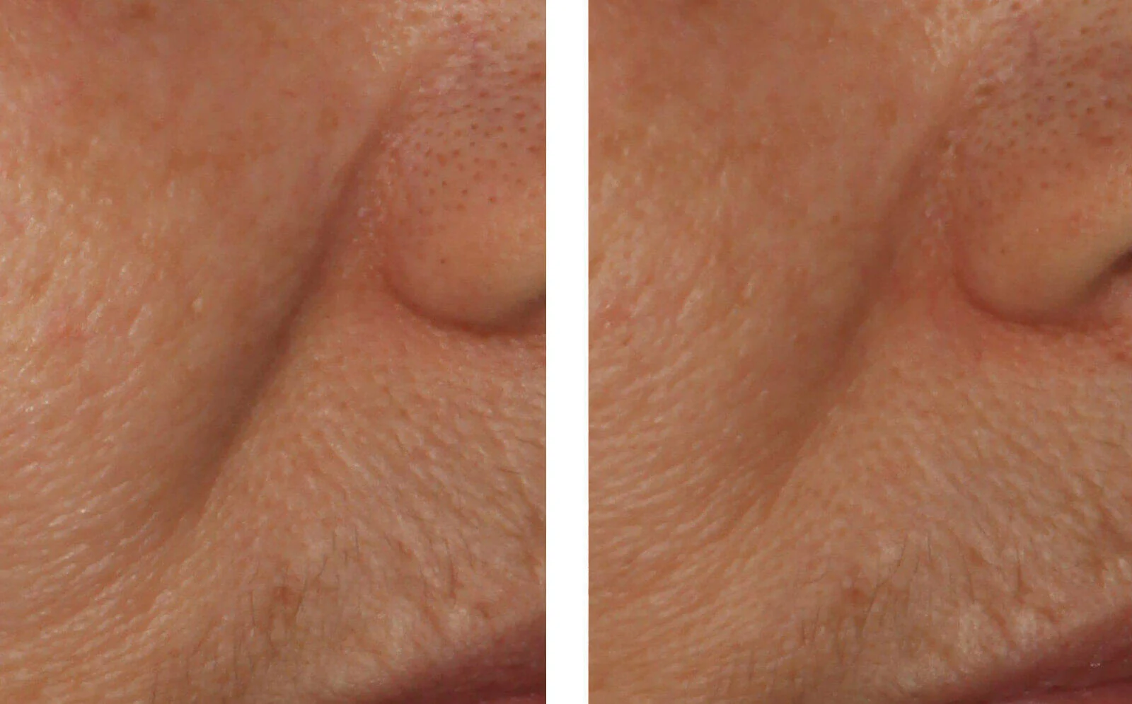 SkinBetter Science® InterFuse® Intensive Treatment LINES