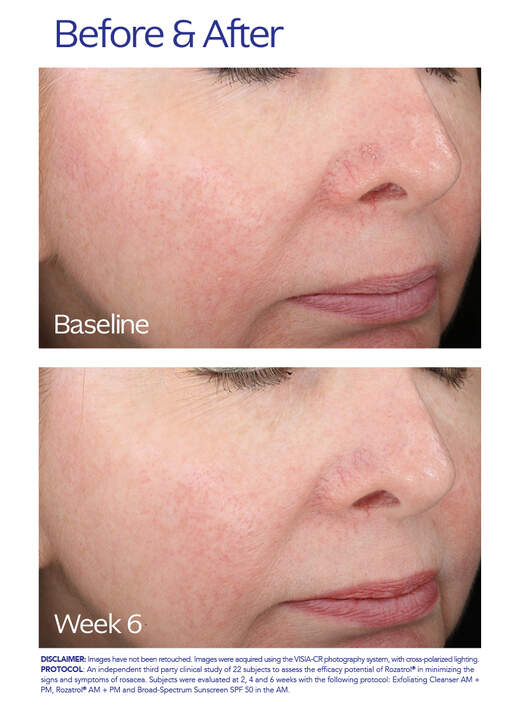ZO® Skin Health Rozatrol