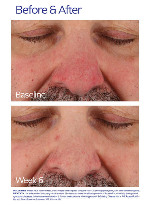 ZO® Skin Health Rozatrol